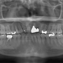 レントゲン撮影