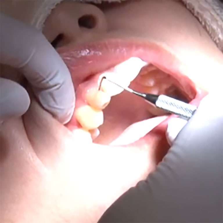 ⻭周病精密検査