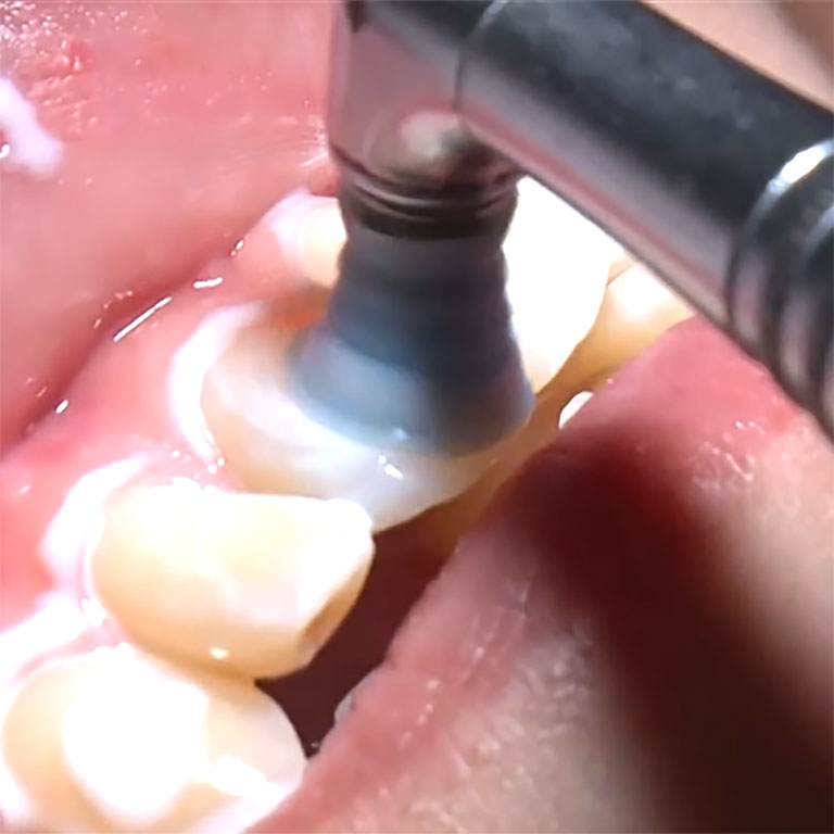 バイオフィルムの除去