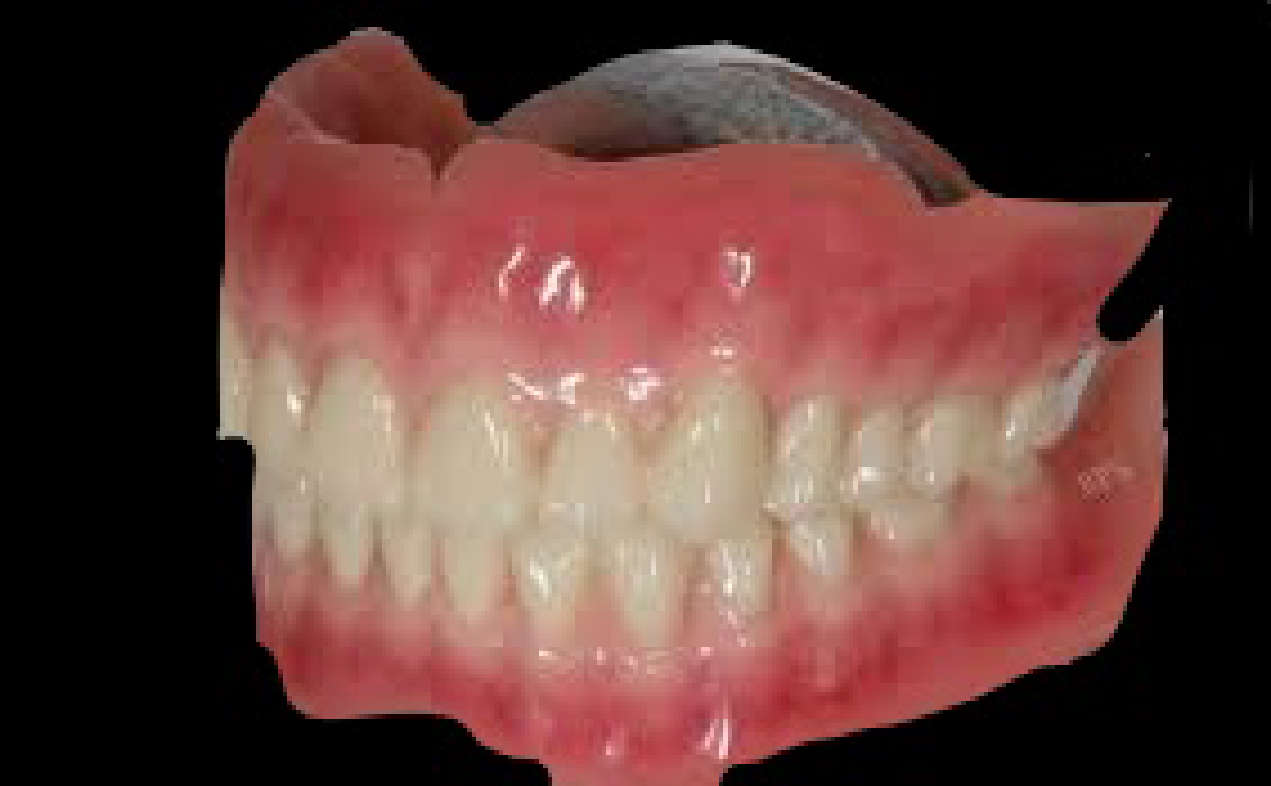 吸着デンチャーライズデンタル