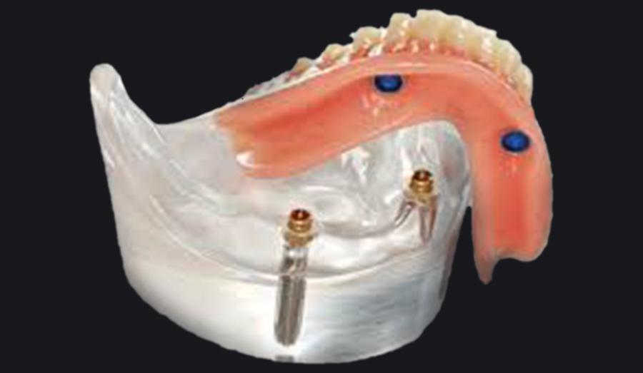 インプラントオーバーデンチャー