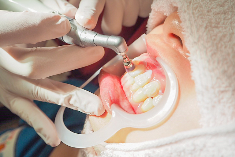 歯のクリーニング