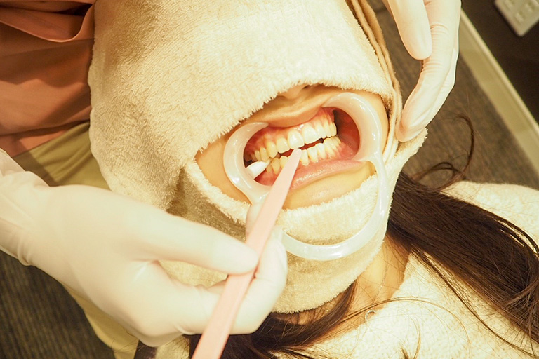 ホワイトニング開始